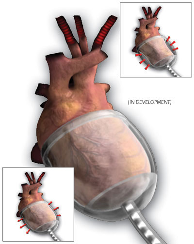 pompa cardiaca temporanea