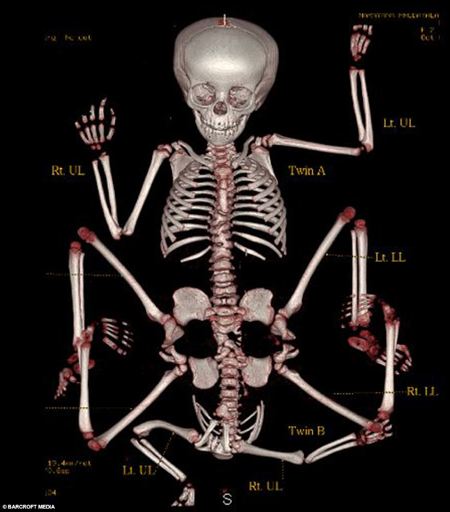 scheletro bambina quattro 4 gambe braccia