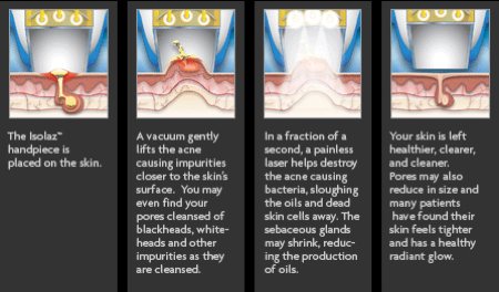 thérapie au laser contre l'acné