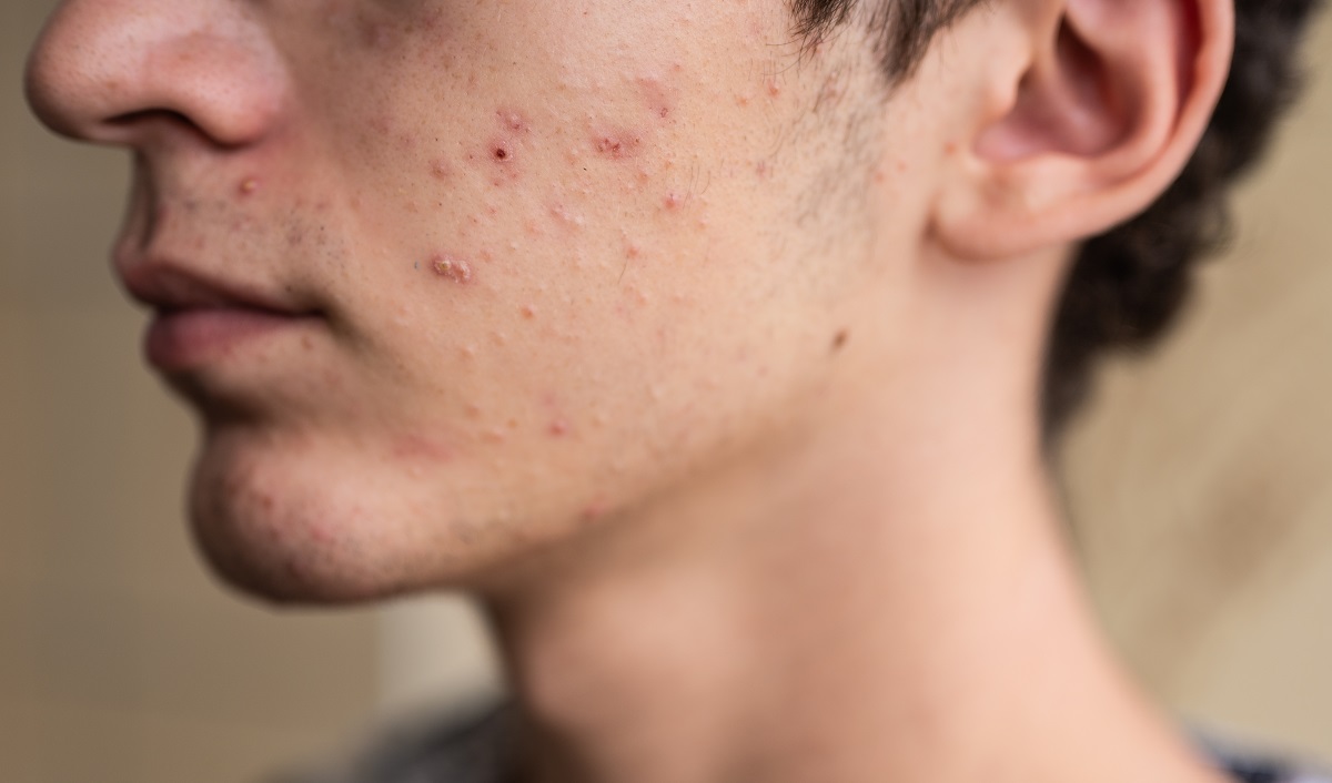 Cause E Trattamenti Dell Acne Negli Uomini BioBlog